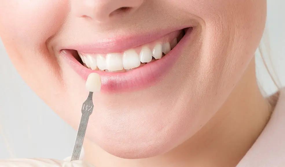 What Are Veneers?