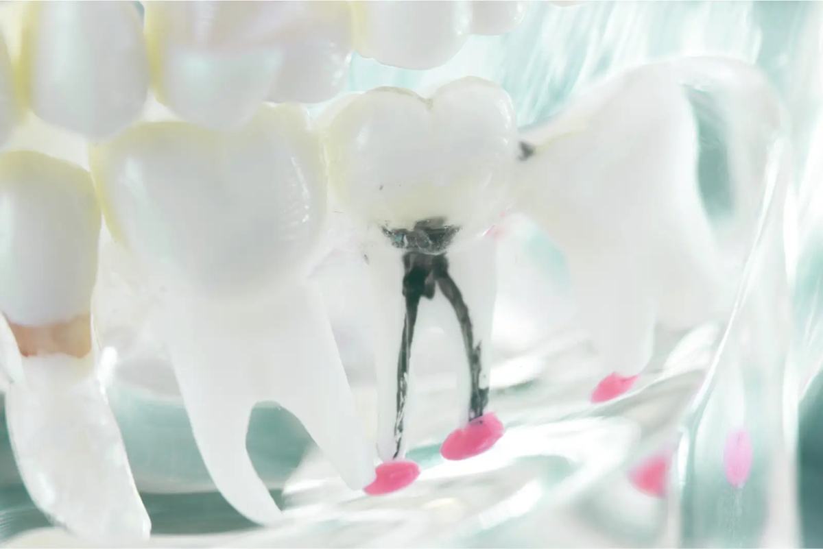 Understanding Root Canal Treatment