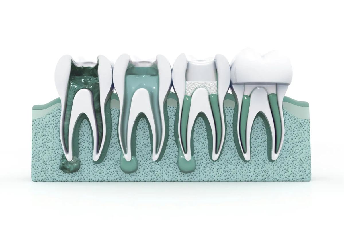 Understanding the Root Canal Process