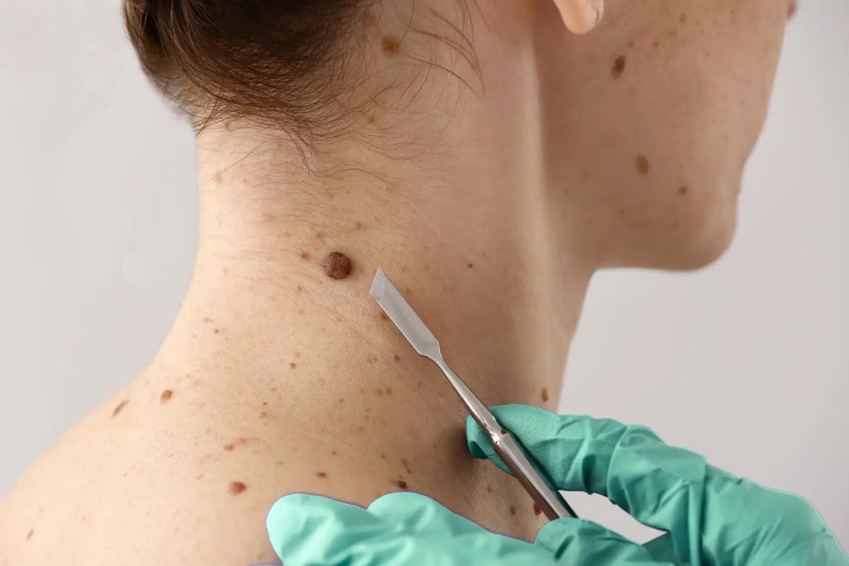 A minor skin procedure performed by a physician